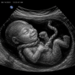 Umbilical Cord Around the Baby’s Neck