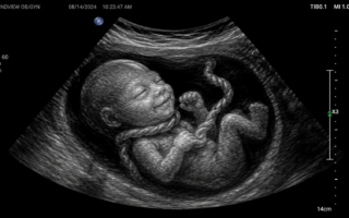 Umbilical Cord Around the Baby’s Neck