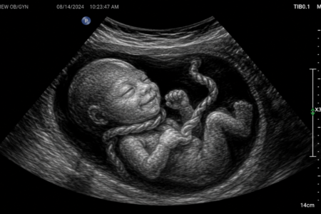 Umbilical Cord Around the Baby’s Neck